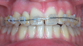 orthodontiste Chalon-sur-Saone appareil