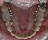 orthodontiste Chalon-sur-Saone appareil bouche
