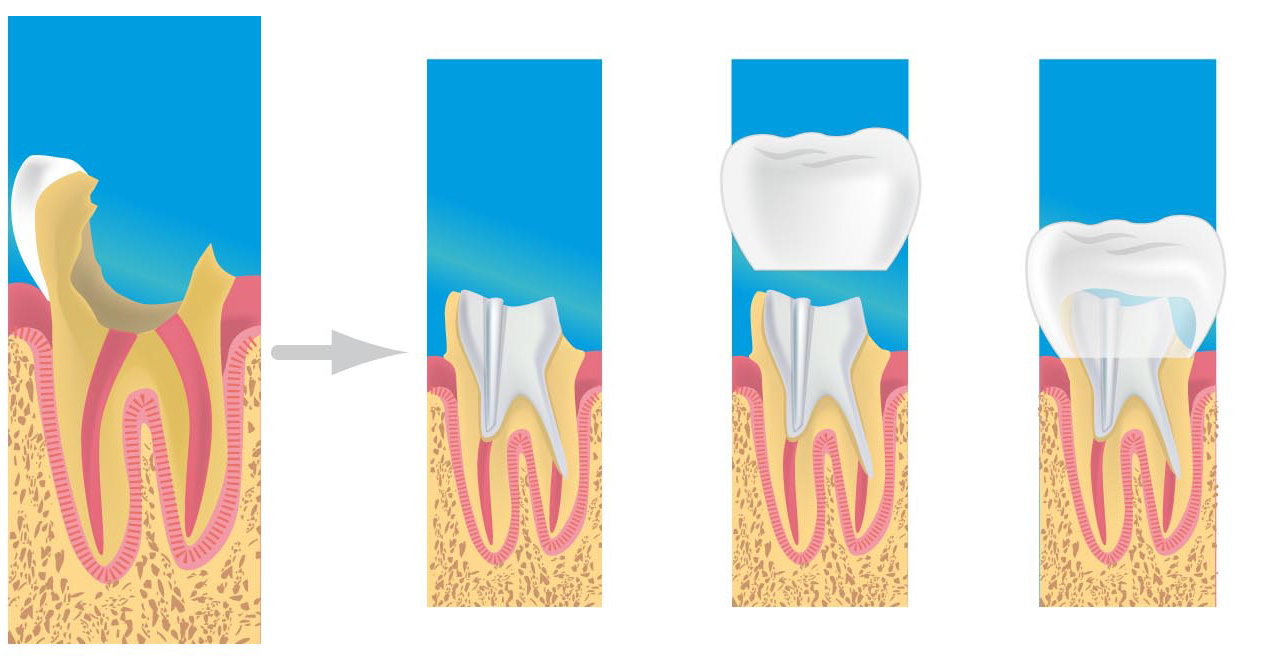prothese dentaire chalon sur saone