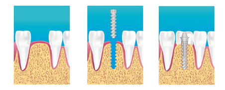 Implant dentaire à Chalon-Sur-Saone